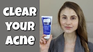 HOW TO CLEAR YOUR SKIN WITH BENZOYL PEROXIDE DR DRAY [upl. by Hamo]