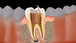 Root canal treatment RCT Procedure animation [upl. by Anileva293]