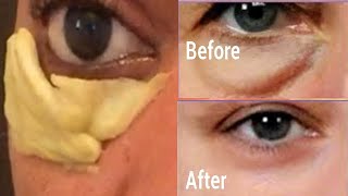 EASY REMEDY TO REMOVE EYE BAG AND PUFFY EYE FAST [upl. by Christa274]