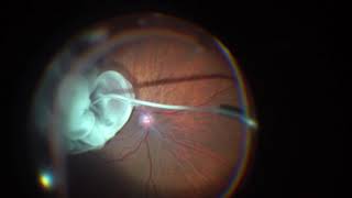 vitrectomy for macular pucker Epiretinal Membrane [upl. by Gotcher]