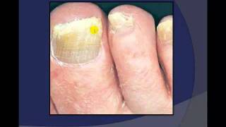 Toenail Debridement by a Podiatrist [upl. by Sletten]