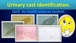 Urinary cast identificationQuiz for health science students [upl. by Leake962]