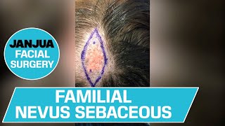 FAMILIAL NEVUS SEBACEOUS  DR TANVEER JANJUA  NEW JERSEY [upl. by Atinad]