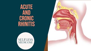 ACUTE RHINITIS with important questions [upl. by Fishman]