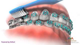 Life with Braces  Brushing amp Flossing [upl. by Curnin891]