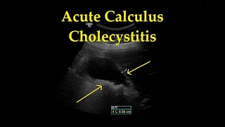 How To Gallbladder Ultrasound Part 3  Acute Cholecystitis Case Study Video [upl. by Lewak602]