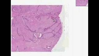 Histopathology BreastFibroadenoma [upl. by Syned]