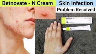 Betnovate N Cream Review  Benefits amp Uses  Betnovate N Cream for Face Acne Pimples [upl. by Otreblig]