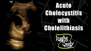 Gallstones and Cholecystitis  Signs Symptoms And Treatment [upl. by Enwahs]