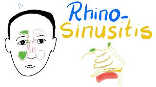 Rhinosinusitis Acuteamp Chronic Clinical Picture Diagnosisamp Management  Cases [upl. by Acir]