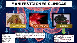 Hemorragia digestiva baja HDB Etiología Diagnóstico y Tratamiento manejo [upl. by Lyssa]