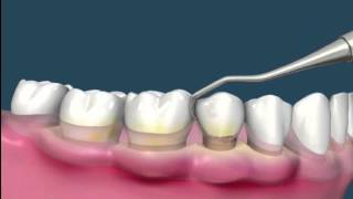 Raspado de encías  Periodoncia [upl. by Yeldud626]