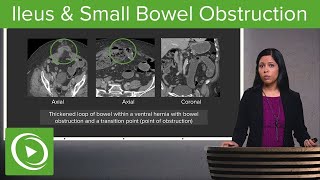 Bowel Obstruction and Ileus Ileus amp Small Bowel Obstruction – Radiology  Lecturio [upl. by Ellimak]