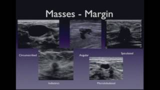 Short Review General Overview of Invasive Ductal Carcinoma Breast [upl. by Mahgem286]