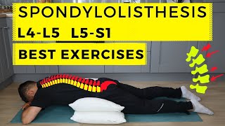 Spondylolisthesis treatment [upl. by Inglebert]