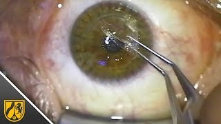 Augen lasern in 26 Sekunden So läuft die Operation mit der RelexSmileMethode [upl. by Nyladnewg302]