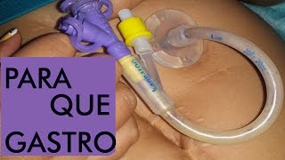 Gastrostomía Qué es pros y contras [upl. by Yelroc537]