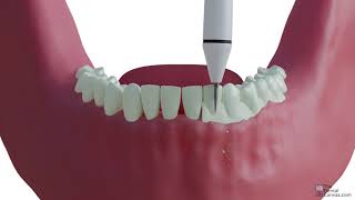 Scaling  Dental Procedures [upl. by Harlen]