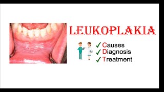 Leukoplakia  Causes Diagnosis amp Treatment [upl. by Nattirb]