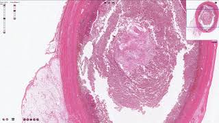 Acute Appendicitis  Histopathology [upl. by Moulden]