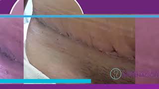 Abdominoplastia  Proceso de cicatrización [upl. by Liahkim]