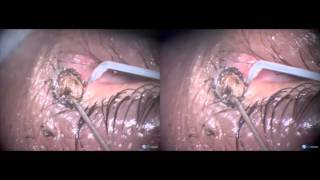 Large naevus on punctum and canaliculus removal with Fugo blade [upl. by Sahpec653]