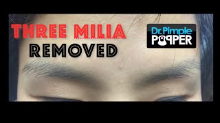 Three milia extracted on the face [upl. by Laise]