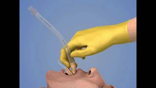 Laryngeal Mask Airway Insertion [upl. by Pas]