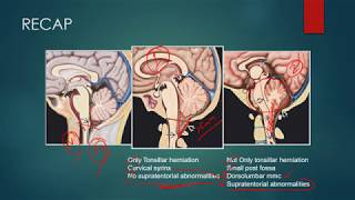 CHIARI MALFORMATIONS RADIOLOGY CT MRI [upl. by Aicilaanna]