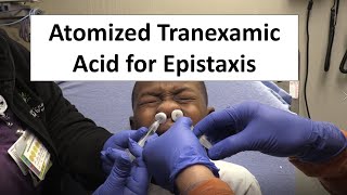 Atomized Tranexamic Acid for Epistaxis Control [upl. by Lleira]