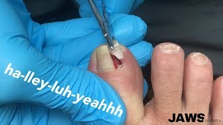 REMOVING A LARGE INGROWN TOENAIL [upl. by Outhe]