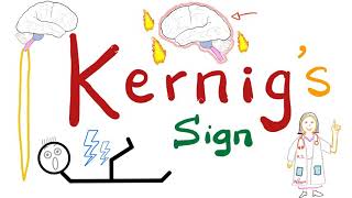 Kernig Sign  Meningitis  Neurology Physical Exam [upl. by Enar85]