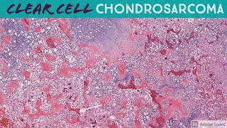 Clear Cell Chondrosarcoma [upl. by Parsons]