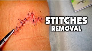 REMOVING 13 STITCHES From a Huge Leg Wound  Dr Paul [upl. by Godliman]