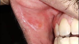 How to clear white patch in the mouth [upl. by Evvy]