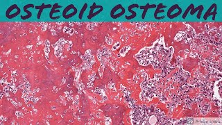 Osteochondroma Exostosis Bone Pathology Basics [upl. by Nonna]