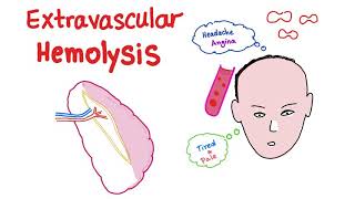 Extravascular Hemolysis [upl. by Yentnuoc]