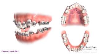 4 Second Bicuspid Extraction  Orthodontic Treatment [upl. by Lantz437]