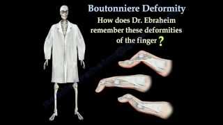 Boutonniere Deformity  Everything You Need To Know  Dr Nabil Ebraheim [upl. by Sweyn]