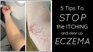 HEALING ECZEMA  5 Things I Do Each Day To STOP THE ITCH [upl. by Kreiner]