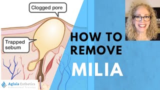 HOW TO REMOVE A MILIA STEP BY STEP  NATURALLY [upl. by Nee]