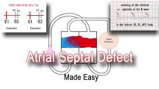 Atrial Septal Defect ASD Pathophysiology amp Clinical Features [upl. by Marie148]