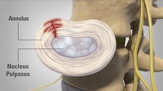 Patient Animation  Lumbar Degenerative Disc Disease [upl. by Krystle]