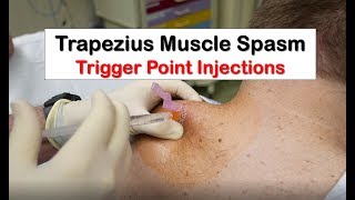 Trapezius Muscle Spasm Trigger Point Injection [upl. by Syck]