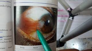 PTERYGIUM verry IMPORTANT conjuctival condition explanation with scenario [upl. by Eisset]