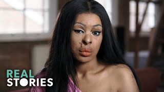 ACID ATTACK My Story Crime Documentary  Real Stories [upl. by Eeloj]