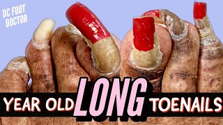 Year Old Long Toenails Trimming Extremely Long Toenails [upl. by Nalehp]