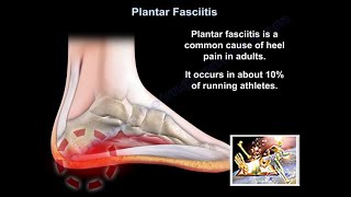 Plantar Fasciitis  How I Fixed My Plantar Fasciitis Problem With Dr Scholls Orthotics [upl. by Mailliwnhoj971]