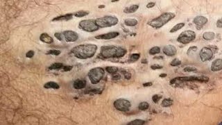 Nevus Blackheads Comedones and Dilated Pores of Winer [upl. by Haisoj526]