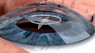 Watch live surgery using the laser cataract system  how does it work Eye News TV [upl. by Constance]